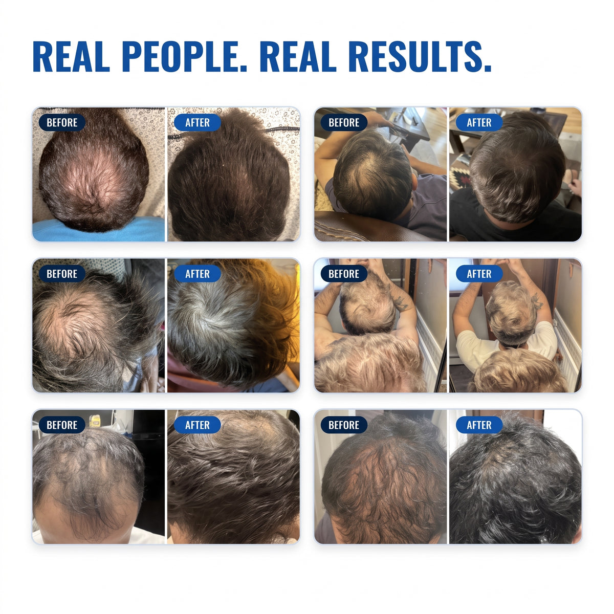 Sunnde Labs PepStack+™ Infusion Kit For Hair Regrowth