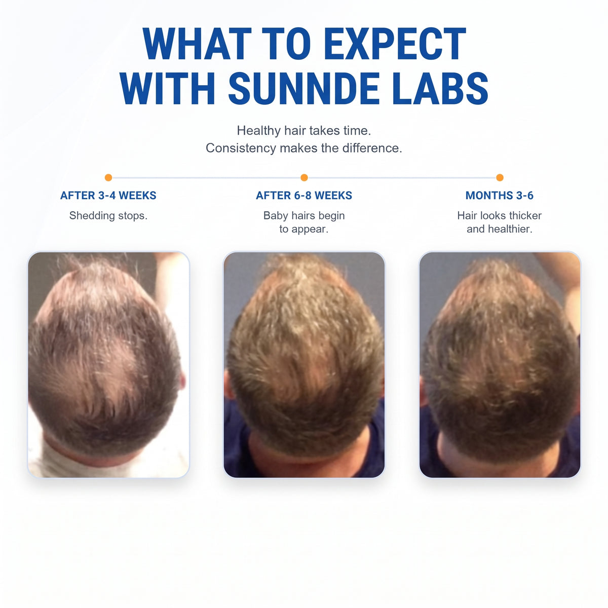 Sunnde Labs PepStack+™ Infusion Kit For Hair Regrowth